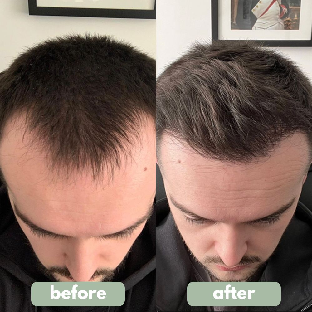 MRGROWTH™ Hair Density Roll-On Serum